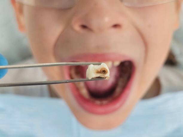 Best Urgent Tooth Repair  in Mountain View, AR